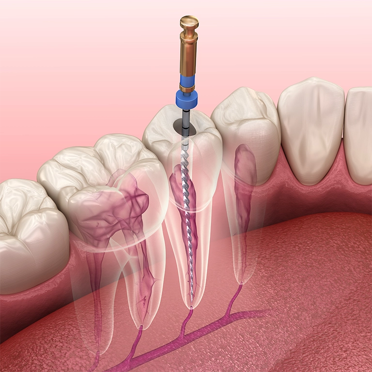 3D illustration showing root canal treatment procedure on molar tooth at Smile Circle Dental