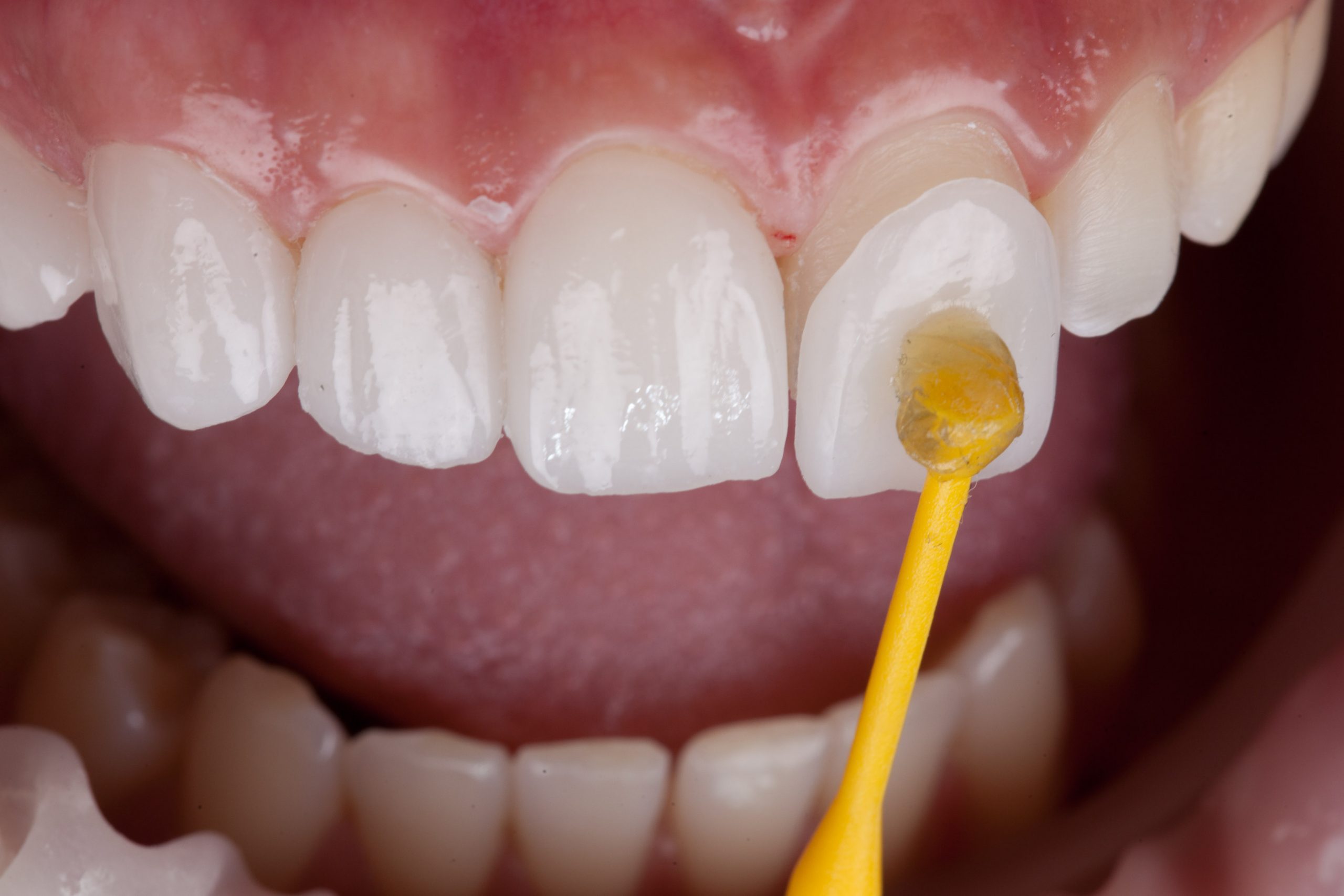 Close-up of dental veneer application process showing adhesive being applied to a front tooth