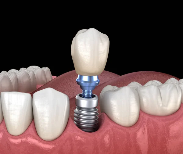 3D dental rendering showing a dental implant with crown placement for tooth restoration