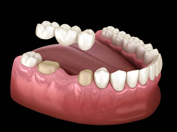 3D dental illustration showing a dental bridge placement on lower molars for tooth restoration