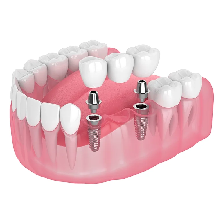 3d render of jaw with implants supported dental bridge