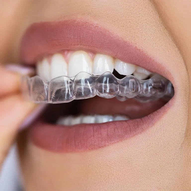 Clear Aligner Dental Night Guard