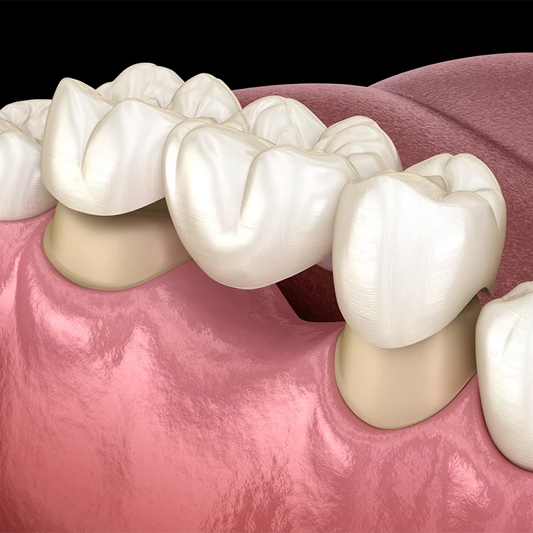 Dental bridge of 3 teeth over molar and premolar Medically accurate 3D illustration of human teeth treatment