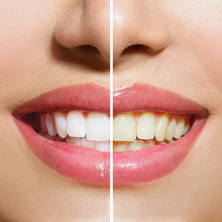 Woman Teeth Before and After Whitening Oral Care