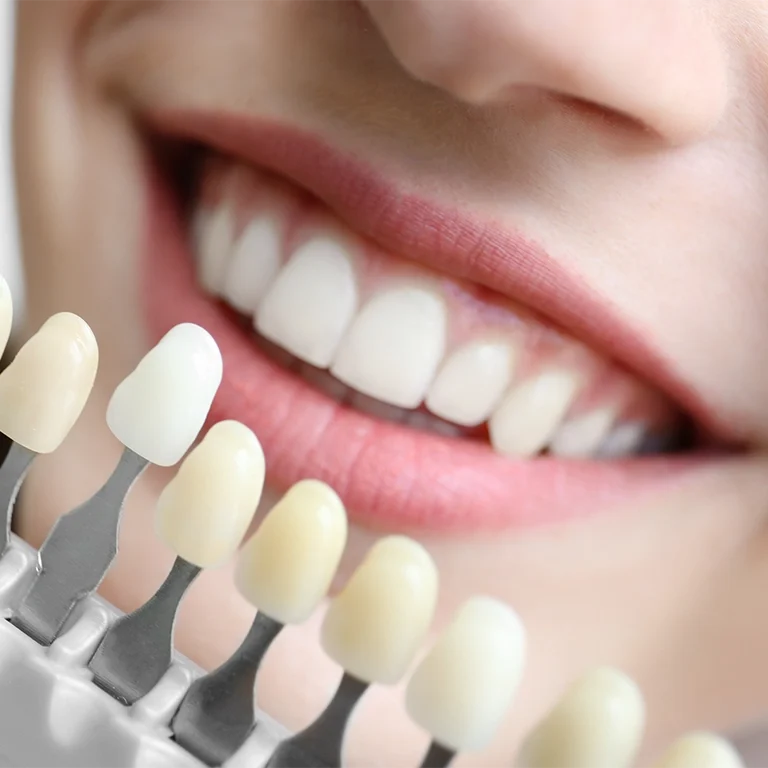 Young woman choosing color of teeth at dentist, closeup